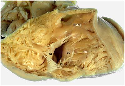 Multi-Modality Imaging for Interventions in Tricuspid Valve Disease